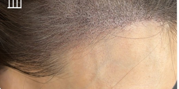 頭皮アートメイク（生え際）【40代・女性】アフター