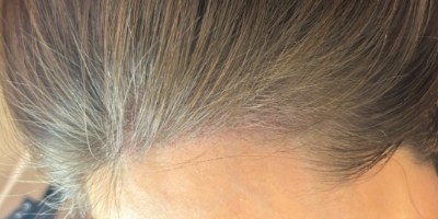 頭皮アートメイク（生え際）after