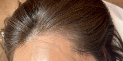 頭皮アートメイク（生え際）before